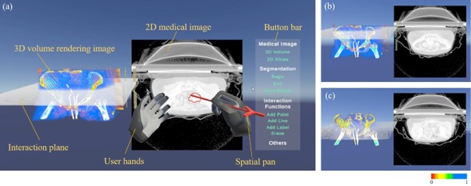 20230521-0033990威尼斯医学院博士生张楠、杨讷与李阳曦在中国生物医学工程大会暨创新医疗峰会上获奖-张楠-基于三维空间交互的宫颈癌靶区勾画虚拟现实环境总览.jpg